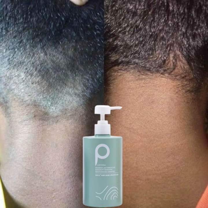 Syampoo Kelemumur Dan Gatal Kepala Psoriasis Scalp Itchy Scalp Anti