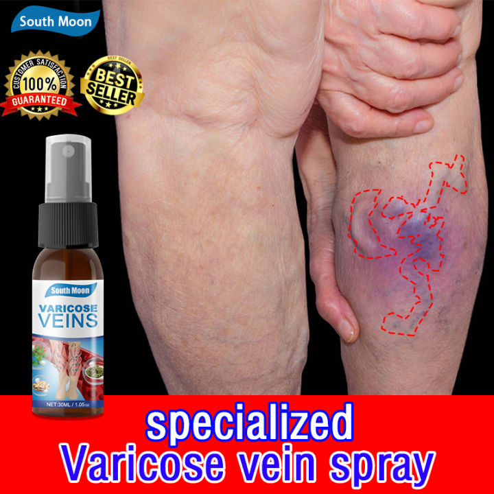 Southmoon Varicose Vein Removal Spray Ml Effective Treatment Of Leg