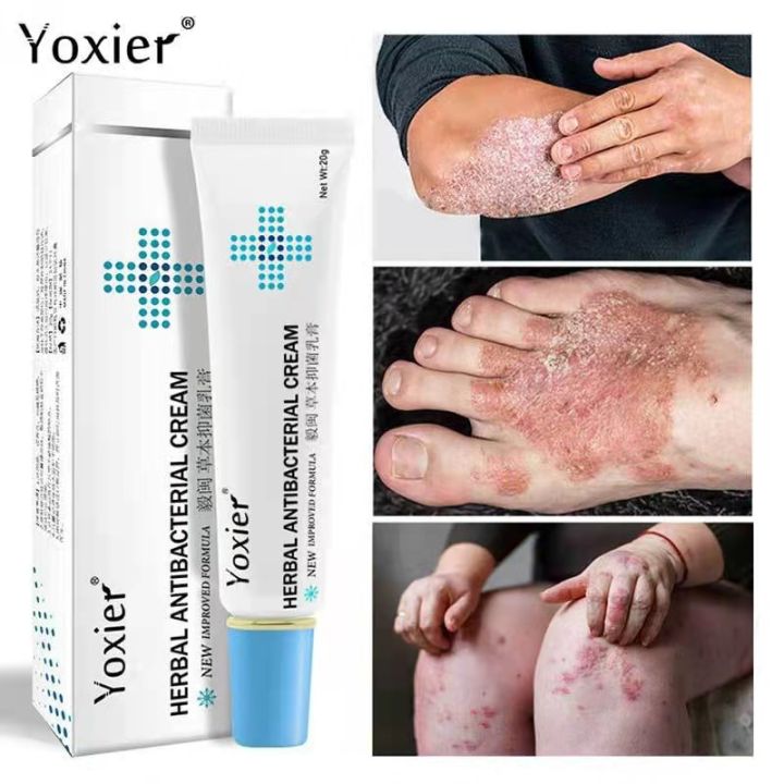 Yoxier Herbal Cream Eczema Ointment Treatment Of Psoriasis