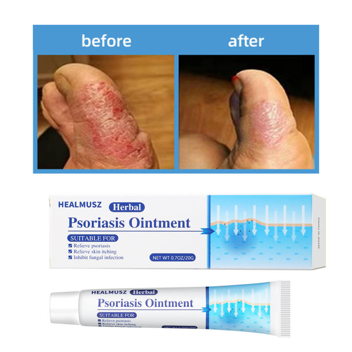 Psoriasis Antibacterial Cream G Topical Skin Inhibition Bacteria