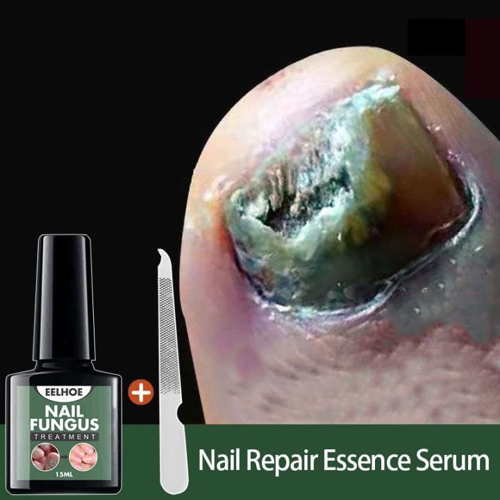 Eelhoe Nail Repair Essence Serum Fungal Nail Treatment Remove