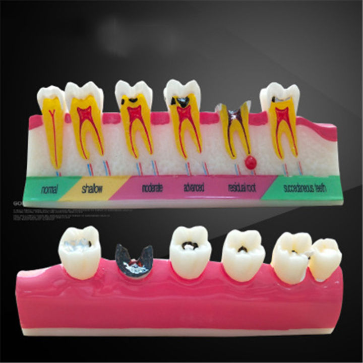 Tooth Model Caries Classify Dental Model Of Pathological Process Around