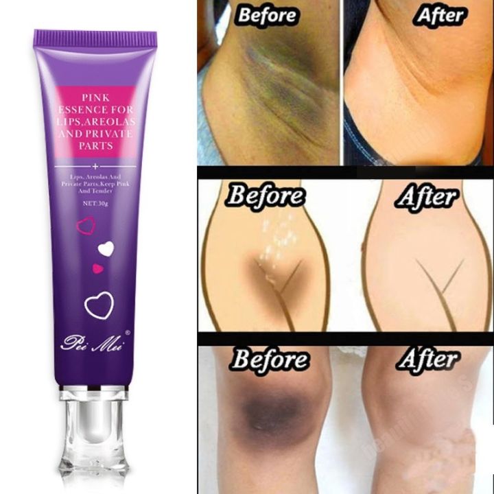 Private Parts Whitening Cream Neck Knee Remove Melanin Underarm