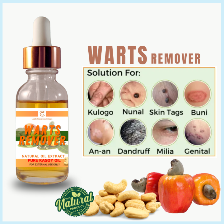 Original Warts Remover Pure Organic Kasoy Oil 15ML Effective Remover