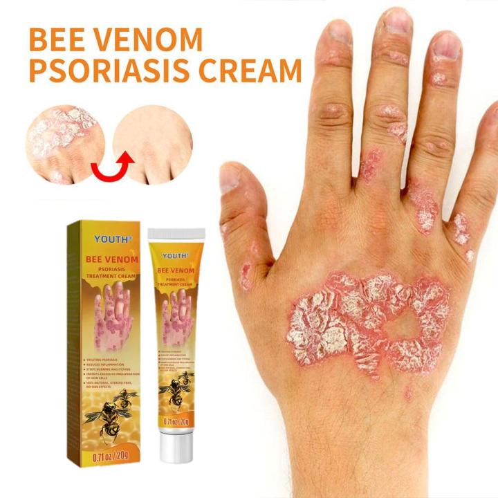 Eczema Treatment Cream Psoriasis Ointment Antibacterial Cream Anti