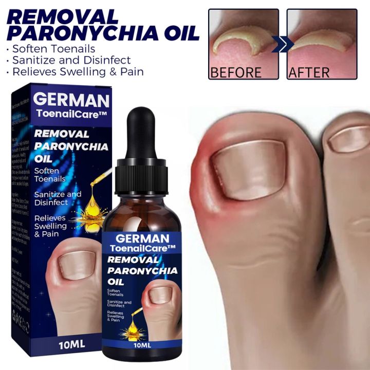 German Toenailcare Removal Paronychia Oil German Toenailplus Anti