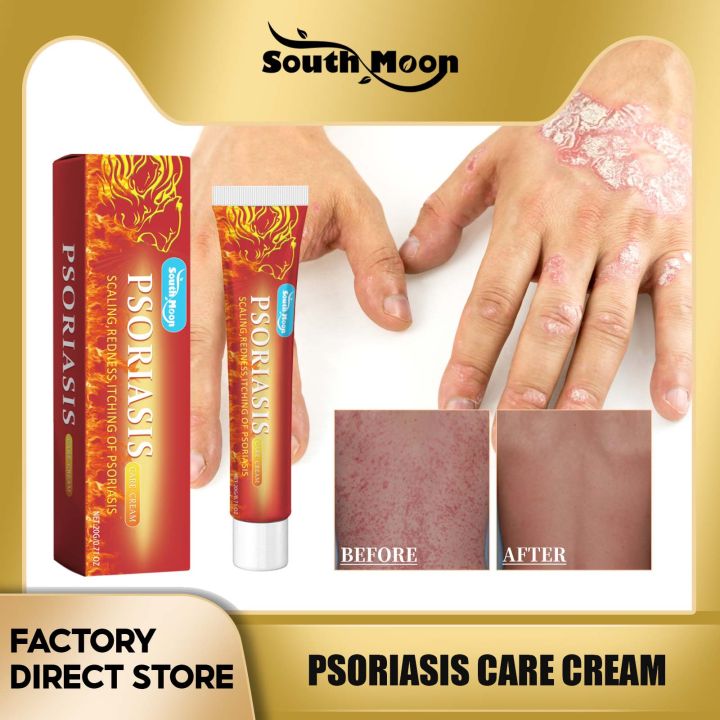 South Moon Psoriasis Care Cream Treatment Eczema Dermatitis