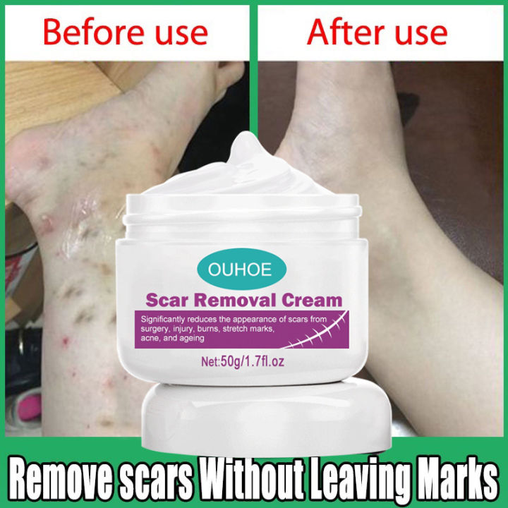 Scar Remover For Old Scar On Leg Stretch Mark Remover Acne Scar Remover