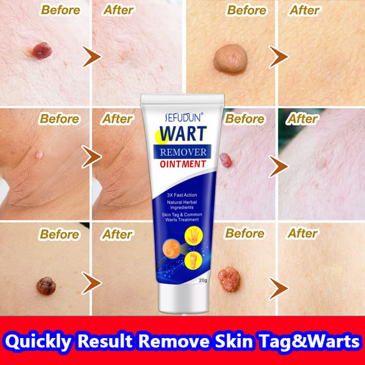 Warts Remover Original Cream Original Warts Magic Remover Wart Ointment