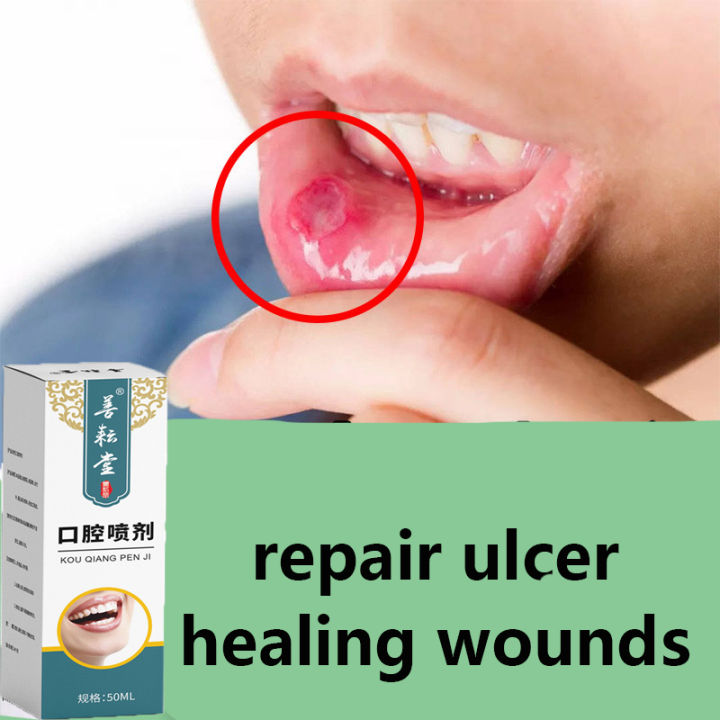 Effect Quickly Canker Mouth Sore Solution Ml Treatment Mouth Sore