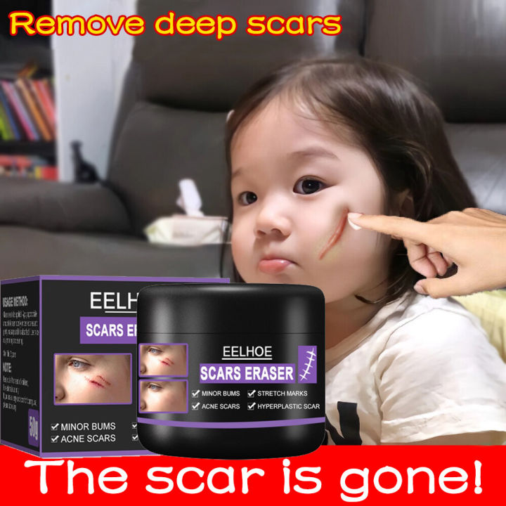 Eelhoe Scar Remover Scar Remover For Old Scar On Leg Stretch Mark