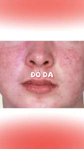 (Combo B5 2 Món + Tặng Kem Chống Nắng 20g) Bộ Đôi B5 Phục Hồi Đa Tầng Và Dưỡng Trắng Da Serum B5 30ml Kem ViTa B5 (Miss CanDy) (Hàng Chính Hãng)