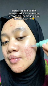 Suncreen Luxury & Acne Spot Gel Reglow: Melindungi Kulit dari Sinar Matahari dan Meredakan Jerawat