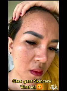 Rangkain Perawatan Wajah dengan Tooner Acne & Tooner Glow oleh MIRGLOW