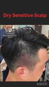 NANO HAIR GROWTH CLINIC Anti Sensitive Scalp Shampoo