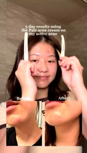 Lion PAIR Acne Pimple Cream 24G