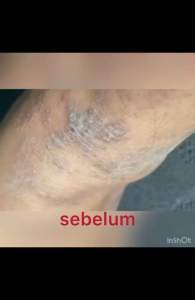 KRIM GATAL ALOEVERA ANTIFUNGAL