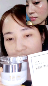 CHÍNH HÃNG Kem Phục Hồi Da Nhiễm corticoid Da Mỏng Yếu Lộ Mao Mạch Da Khô Ráp