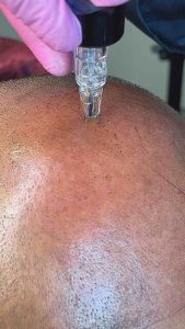 Season Der Automatic Dot Scalp Pigmentation Tool Machine