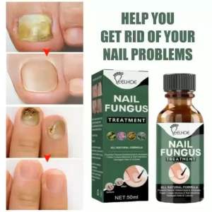 NAIL FUNGUS TREATMENT Rawatan Kuku nail repair penghapus kulat kuku baiki kuku rosak hitam kuning