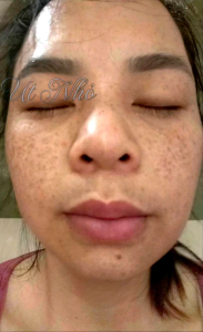 tinh chất bậc gốc tàn nhang nám . hủ 15g. YODY PHƯƠNG ANH