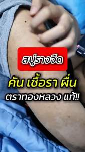 📌คันเรื้อรัง 10 ปี ล้างสารด้วย สบู่รางจืด ตราทองหลวง🌱