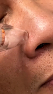 Pembersih komedo Wajah Elektrik alat facial Remover Vacuum Facial Cleaner Listrik Jerawat  Kit dengan 3 Kepala Hisap untuk Wanita Electric