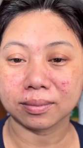 N203R 9% AHA Peeling Serum Perfect Exfoliating Solution