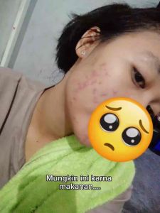 Paket Skincare Acne Glowing Platinum Orlin Beauty Membantu Mencerahkan Wajah Kulit Sensitif Bekas Berjerawat Flek Hitam Bpom