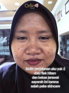 Orlin Beauty skincare Paket Flek platinum Crean flek pemudar flek hitam dan Bintik Hitam