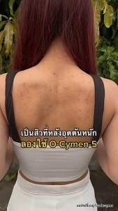 🍊สิวที่หลัง เจลอาบน้ำมิวซุ yuzu เจลอาบน้ำยูซุ Organic มี Biosol ผดผื่น สิวหลัง สิวหน้าอก