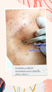 รุ่นใหม่2024หัวรี แถมฟรีเข็มเจาะสิว10ชิ้น ที่กดสิว ไม้กดสิว คารีน karene คลินิกใช้