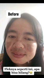 Paket Perawatan Flek Hitam Orlin Beauty: Krim BPOM & Flek Bandel Hilang