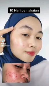 Serum Tea Tree Acne BG Skin