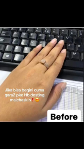 MALCHASKIN HB DOSTING 3 botol