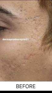TCA 100% 15ml Solution Potent and Pure Cross with Hydrocort Cream for Scars Warts Acne