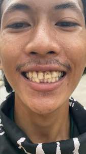 [FREE SIKAT GIGI] Original Bodyaccel Odol Viral Pemutih Gigi dan Karang Gigi Pemutih Menghilang Noda Kopi&Teh 100% Orisinal Pasta Gigi Yang Menyegarkan Nafas