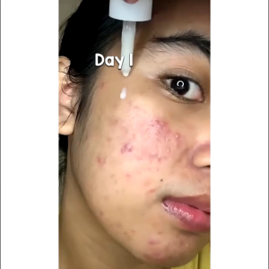 glow fx acne pure serum serum untuk jerawat meradang terlaris