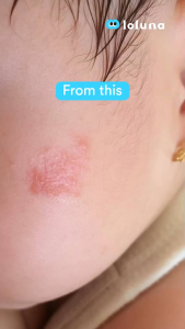 Loluna Cerapair Rash Cream 30ml - Krim bayi ruam iritasi & gigitan serangga