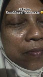 Byzoe 5 in 1 Korean Face Peeling Mask