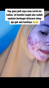 Paket ACNE HEMAT Orlin: Mencerahkan & Membantu Mengobati Jerawat\\n\\n Apa Itu Paket ACNE HEMAT Orlin?\\n\\nPaket ACNE HEMAT Orlin merupakan paket perawatan kulit yang dirancang khusus untuk membantu mengempeskan jerawat dan meredakan jerawat meradang ampuh. Paket ini dirancang dengan komposisi yang tepat untuk mencerahkan dan mengobati jerawat, sehingga kulit Anda akan tampak lebih bersih dan sehat.\\n\\n Komposisi Paket ACNE HEMAT Orlin\\n\\nPaket ACNE HEMAT Orlin terdiri dari beberapa produk yang dirancang untuk merawat kulit Anda secara menyeluruh. Berikut adalah komposisi paket ACNE HEMAT Orlin:\\n\\n- **Sabun Pembersih**: Sabun pembersih yang dirancang khusus untuk membersihkan kulit dari kotoran dan minyak berlebih.\\n- **Toner**: Toner yang dirancang untuk meredakan jerawat meradang ampuh dan mencerahkan kulit.\\n- **Krim Malam**: Krim malam yang dirancang untuk membantu mengempeskan jerawat dan mencerahkan kulit.\\n\\n Manfaat Paket ACNE HEMAT Orlin\\n\\nPaket ACNE HEMAT Orlin memiliki beberapa manfaat bagi kulit Anda, antara lain:\\n\\n- Membantu mengempeskan jerawat\\n- Meredakan jerawat meradang ampuh\\n- Mencerahkan dan mengobati jerawat\\n- Membantu membersihkan kulit dari kotoran dan minyak berlebih\\n\\n Cara Penggunaan Paket ACNE HEMAT Orlin\\n\\nBerikut adalah langkah-langkah penggunaan Paket ACNE HEMAT Orlin:\\n\\n1. Bersihkan wajah Anda dengan sabun pembersih.\\n2. Gunakan toner untuk meredakan jerawat meradang ampuh dan mencerahkan kulit.\\n3. Gunakan krim malam pada malam hari untuk membantu mengempeskan jerawat dan mencerahkan kulit.\\n\\n Tips Efektif Menggunakan Paket ACNE HEMAT Orlin\\n\\nBerikut adalah beberapa tips efektif menggunakan Paket ACNE HEMAT Orlin:\\n\\n- Gunakan paket ini secara teratur setiap hari untuk mendapatkan hasil maksimal.\\n- Hindari memencet jerawat Anda, karena hal ini dapat menyebabkan infeksi dan meninggalkan bekas luka.\\n- Pastikan untuk membersihkan wajah Anda setiap hari untuk menghindari penumpukan kotoran dan minyak berlebih.\\n\\n Hasil yang Bisa Diharapkan Dari Penggunaan Paket ACNE HEMAT Orlin\\n\\nBerikut adalah perubahan kulit yang bisa diharapkan setelah menggunakan Paket ACNE HEMAT Orlin:\\n\\n- Jerawat meradang ampuh akan meredakan.\\n- Jerawat akan mengempeskan.\\n- Kulit akan tampak lebih bersih dan sehat.\\n\\n Testimoni Pengguna Paket ACNE HEMAT Orlin\\n\\nBerikut adalah beberapa testimoni pengguna Paket ACNE HEMAT Orlin:\\n\\n\\\"Saya telah menggunakan Paket ACNE HEMAT Orlin selama beberapa minggu dan saya sangat senang dengan hasilnya. Jerawat meradang ampuh saya telah meredakan dan kulit saya tampak lebih bersih dan sehat.\\\" - Maria\\n\\n\\\"Paket ACNE HEMAT Orlin telah membantu saya mengempeskan jerawat dan mencerahkan kulit saya. Saya sangat senang dengan hasilnya.\\\" - John\\n\\n Kesimpulan\\n\\nPaket ACNE HEMAT Orlin merupakan paket perawatan kulit yang dirancang khusus untuk membantu mengempeskan jerawat dan meredakan jerawat meradang ampuh. Paket ini memiliki komposisi yang tepat untuk mencerahkan dan mengobati jerawat, sehingga kulit Anda akan tampak lebih bersih dan sehat. Dengan menggunakan Paket ACNE HEMAT Orlin secara teratur, Anda dapat mencapai hasil yang diinginkan dan memiliki kulit yang sehat dan cerah.\\\n}