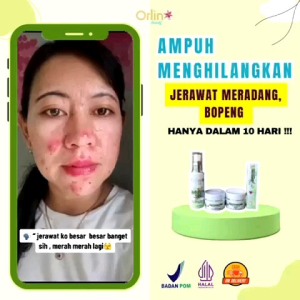 Orlin Beauty Paket Jerawat Krim Bpom ORI Paket Acne Glowing Mencerahkan wajah