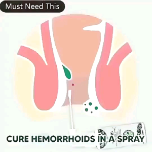 Hemorrhoids cream Krim Buasir Hemorrhoids spray Treatment of mixed internal and external hemorrhoids Relieve itching