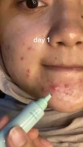 Salep Jerawat 2% Salicylic Acid dari Glad2Glow: Solusi Jerawat Malam