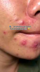 [ORIGINAL] - Sabun bidara penghilang flek hitam alami BPOM