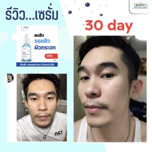 ชุดปราบวงจรสิว หน้าใส ฉ่ำโกลว์ ลดโอกาสการเกิดสิวซ้ำซาก (โฟม40g+เซรั่ม+เจลแต้มสิว)