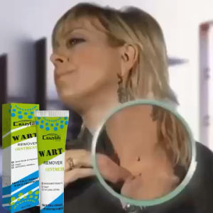 Wart remover cream krim buang ketuat kutil bintik hitam mole remover cream