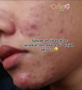 Paket Skincare Acne Glowing Platinum Orlin Beauty Membantu Mencerahkan Wajah Kulit Sensitif Bekas Berjerawat Flek Hitam BPOM