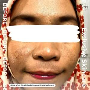 Paket Exclusive Morning Routine Mengatasi Masalah Flek Menyamarkan Noda Hitam Mencerahkan by dr. Oky Pratama Benings Indonesia ( 3iN1 )