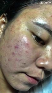 Thuốc Tái Tạo Da Thảo Mộc Linh 100ml Trắng Sáng Sạch Mụn Se Khít Lỗ Chân Lông Dành Cho Làn Da Mụn Không Đều Màu